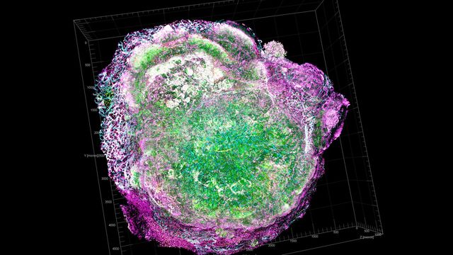 A tumor microenvironment, with different cell types in pink, green and white. 