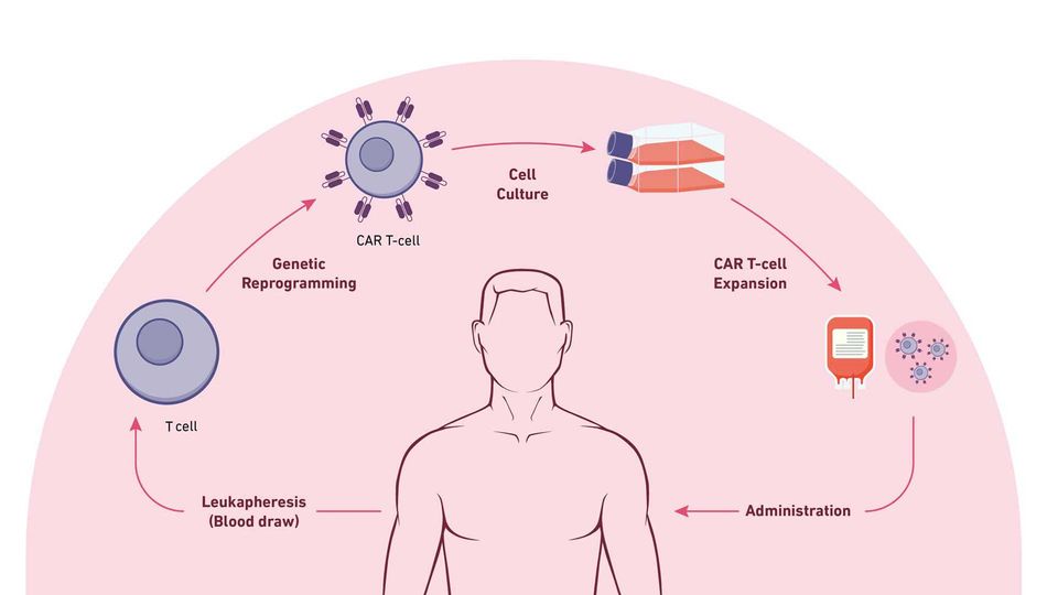 A diagram showing the steps of CAR T-cell therapy