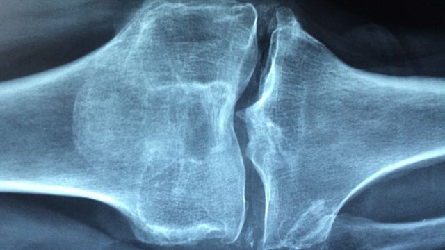 An X-ray of a knee. 